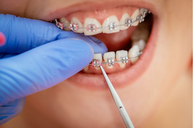 Braces Treatment