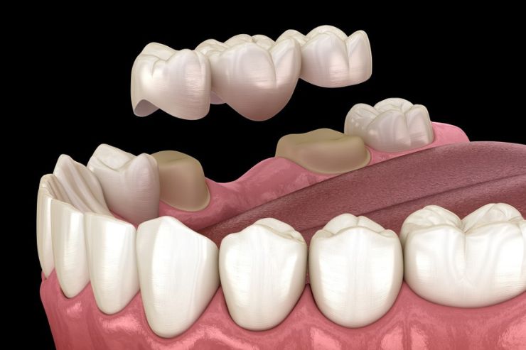 Dental-Bridges_img