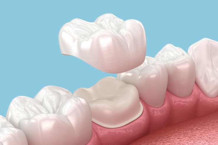 Dental-Crowns_img