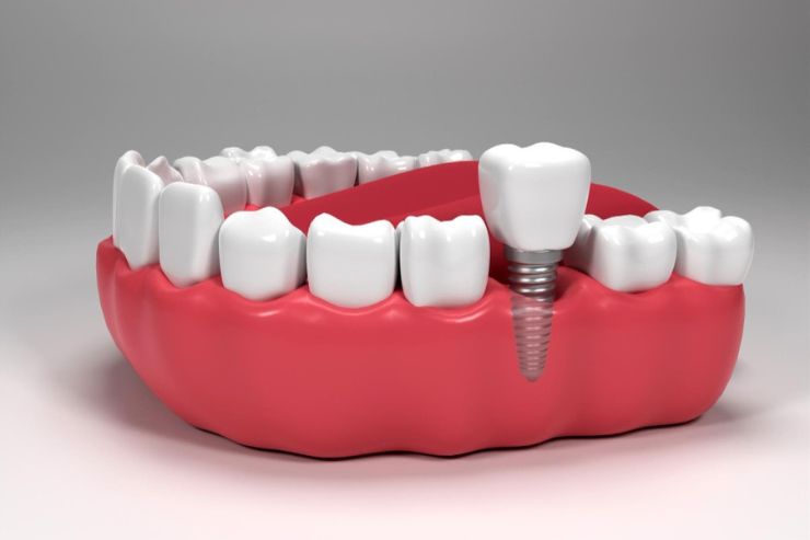 Dental-Implants_img